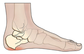 Betegség láb sarok homlok kezelés, lábápolás