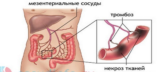 Mi a szívroham és jellemzői (szívinfarktus, szívelégtelenség) Mi a szívroham és jellemzői