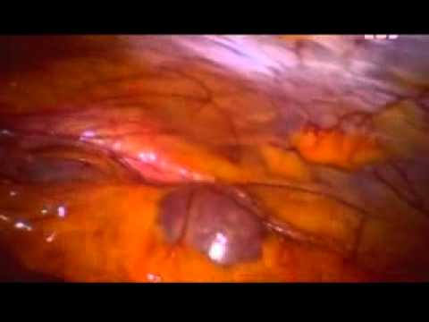 Mi a szívroham és jellemzői (szívroham) Mi a szívroham és jellemzői