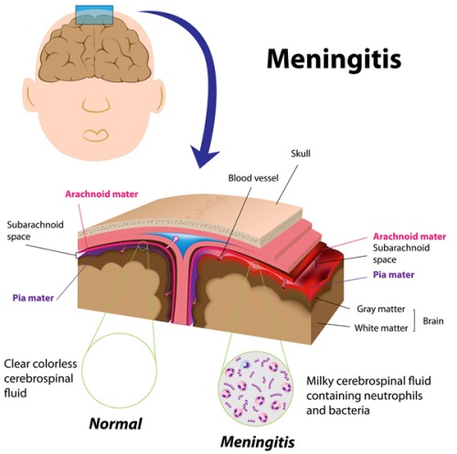 Mi meningitis, mint az agyhártyagyulladás veszélyes felnőtteknek és gyermekeknek