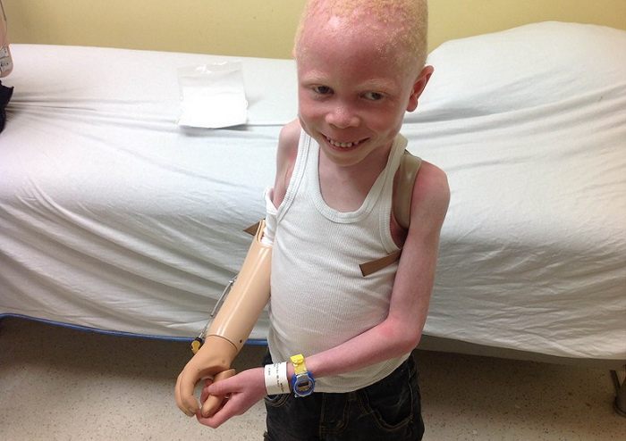 Gyermekek albínó élet, ami hasonlít egy igazi pokol - Infománia