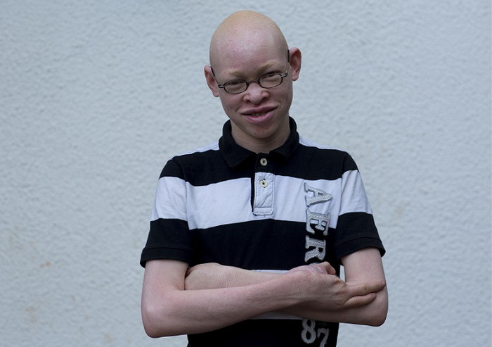 Gyermekek albínó élet, ami hasonlít egy igazi pokol - Infománia