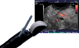 endoszkópos ultrahang