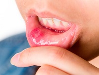 Gombák az ajkak tünetei és kezelése
