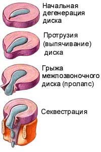 Sérv - álcázott herniatio gerinc (gerincoszlop) Sérv - álcázott herniatio gerinc