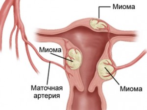 Intramural méhfibrómák mi ez, diagnózis és kezelés (kezelés) Intramural méhfibrómák mi ez, diagnózis, kezelés