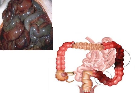 Bél ischaemia típusú, a tünetek, hogyan kell kezelni