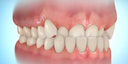 Reimplantácíóhoz alapvető módja a fogak igazítás