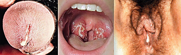 Hogyan és mit kell kezelni gonorrhoea és trichomonas