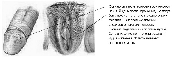 Hogyan és mit kell kezelni gonorrhoea és trichomonas