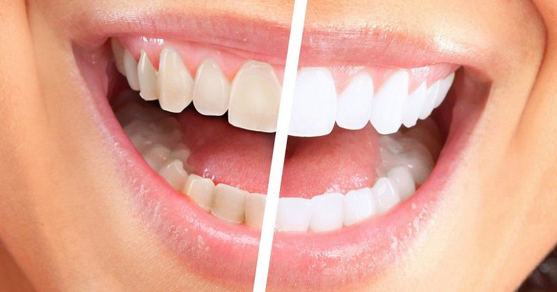 Як відбілити зуби содою в домашніх умовах можна відбілити харчовою содою