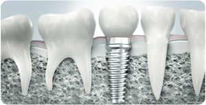 Hogyan enyhíti a fájdalmat, miután a fogászati ​​implantátumok ezért fáj a szomszédos fogak a beültetés után, az elsődleges klinikák