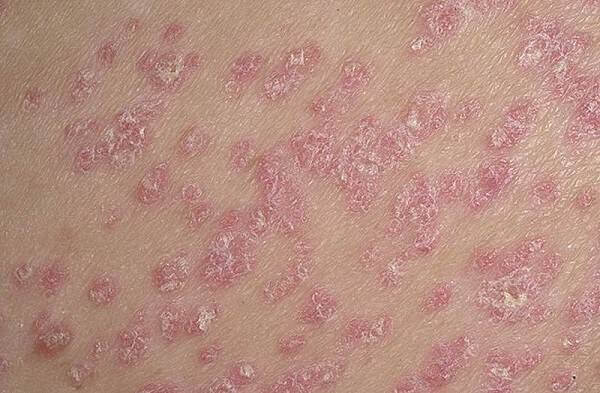 Guttate psoriasis tünetei, fotó, hatékony kezelés