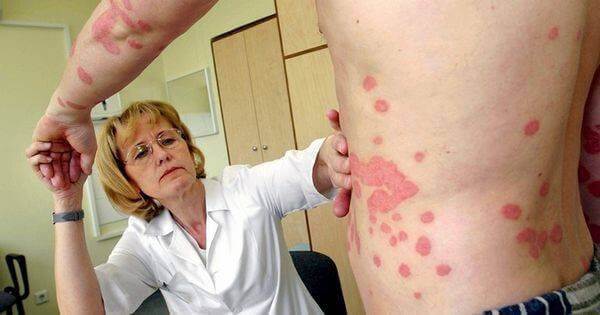 Guttate psoriasis tünetei, fotó, hatékony kezelés