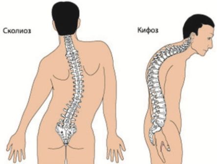 Hyphotikus testtartás és kifoskolioticheskaya mi ez, hogyan jelenik meg (hyphotikus) Hyphotikus testtartás és kifoskolioticheskaya mi ez, hogyan teremthettek