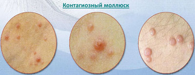 Molluscum contagiosum lézeres kezelés és népi jogorvoslati
