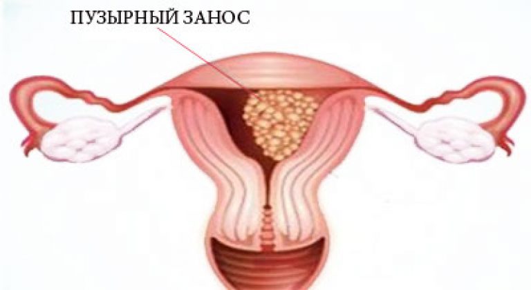Vérzés a terhesség korai szakaszában