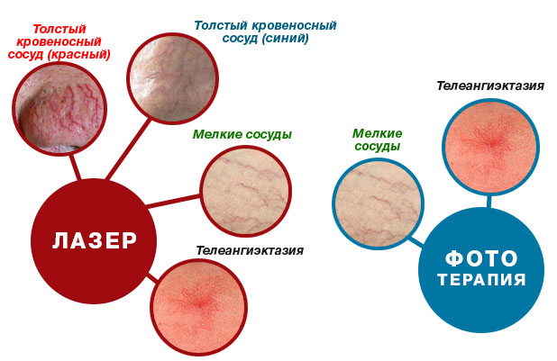 Rosacea arcán fotó okoz, hogyan lehet megszabadulni