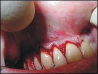 periodontitis kezelése népi jogorvoslat