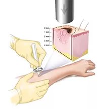 Melanoma bőr előrejelzések az élet, a tünetek és a kezelés (melanoma) Melanoma bőr előrejelzések az élet, a tünetek és a kezelés
