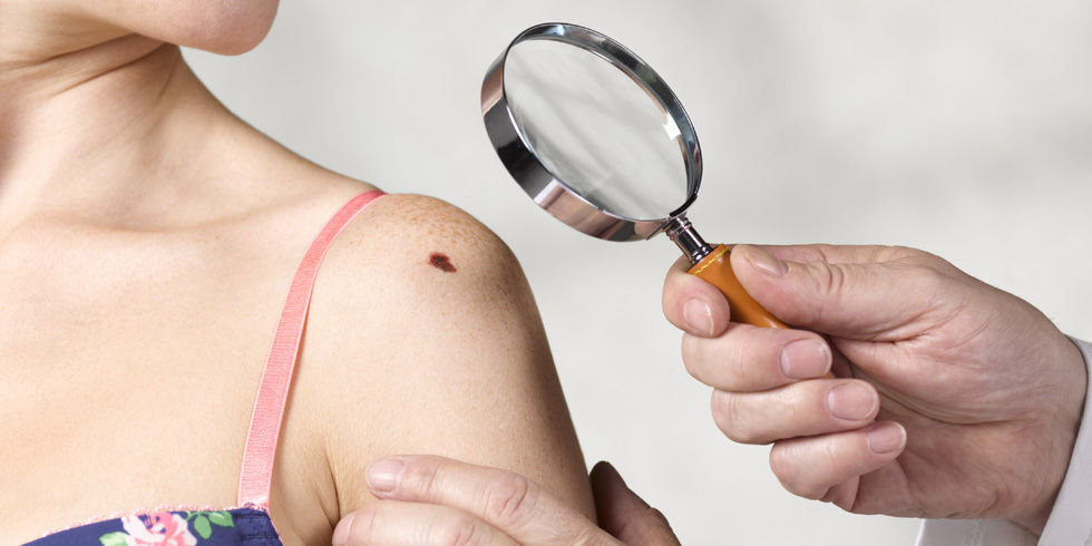 Melanoma bőr előrejelzések az élet, a tünetek és a kezelés