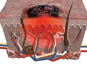 Melanoma bőr előrejelzések az élet, a tünetek és a kezelés