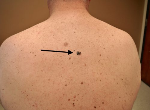Melanoma a bőr a hátulján férfiak utáni állapot daganat kimetszése