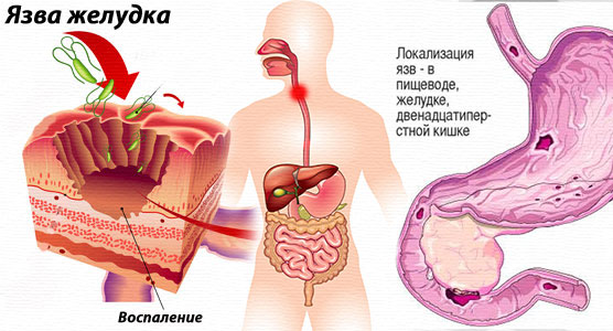 Népi kezelésére nyelőcső fekélyek