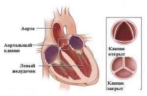 Aorta szelep 2 okok, tünetek, kezelés (kezelés) Aorta szelep 2 okok, tünetek, kezelés