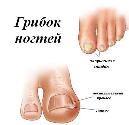 onychomycosis köröm