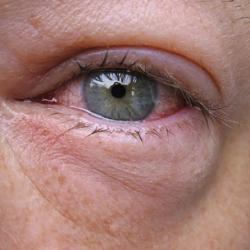 Az árpa szem kezelésében népi gyógyszerekkel gyorsan
