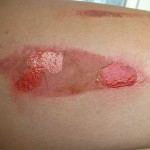 Burn forró tünetek, a kezelés és az elsősegély (égési) Burn forrásban tünetei, kezelése és elsősegély