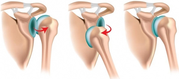 törés a vállízület komplex feladatok kezelésére törés nagyobb tuberosity váll