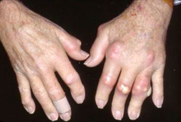 Miért fájó ízületek a kéz a kéz és az ujjak kezelése és okai