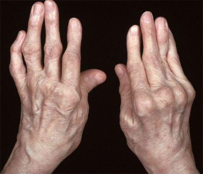Miért fájó ízületek a kéz a kéz és az ujjak kezelése és okai