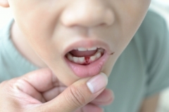 Fogzás és kezelése maradandó fogak gyermekeknél
