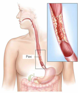 A nyelőcsőrák - az első tünetek, panaszok kezelésére, hány élő műtét után