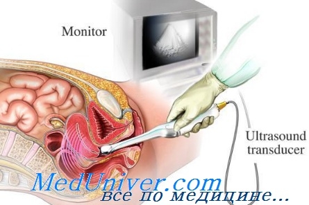 Technika transzvaginális ultrahang (tvuzi) (hüvelyen át) Technika transzvaginális ultrahang (tvuzi)