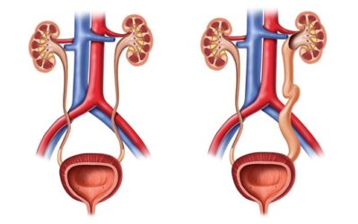 Уретеропіелокалікоектазія що це таке