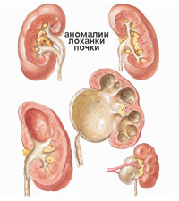 Fokozott vesemedence fetus ultrahang, ultrahang terhesség alatt