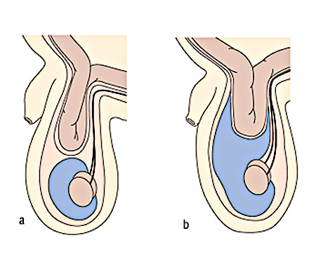 Hydrocele veszélyes nekotorymy esetleges komplikációk (ödéma) Hydrocele veszélyes nekotorymy lehetséges szövődmények