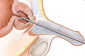 Prosztata adenoma sebészeti betegségek kezelésére
