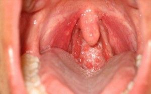 Aphthous stomatitis gyermekek tünetei és kezelése
