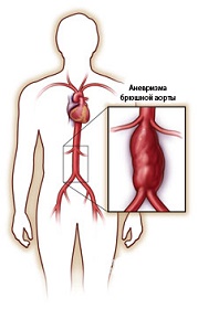 Aortography javallatok, ellenjavallatok, folyamat, stb