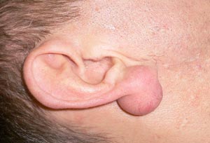 Atheroma fülcimpa okok, tünetek, kezelés