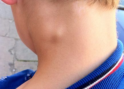 Atheroma a gyermekgondozás és eltávolítása a fül és a gyerekek egy év alatt (törlés) Atheroma a gyermekgondozás és eltávolítása a fül és a gyerekek egy év alatt