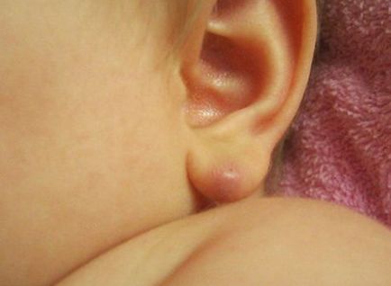 Atheroma a gyermekgondozás és eltávolítása a fül és a gyerekek egy év alatt