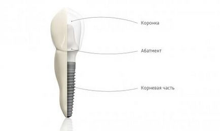 Mi egy ideiglenes implantátum hasznos anyag a páciens kerülnek fogászat