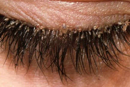 Tar Akne - nyír, áttekintésre, spot-on, kezelésére (acne) Tar Akne - nyír, áttekintésre, spot-on kezelésére