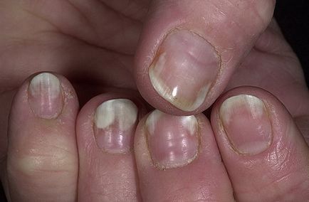 csepegtető köröm gomba remedy for nail fungus infection